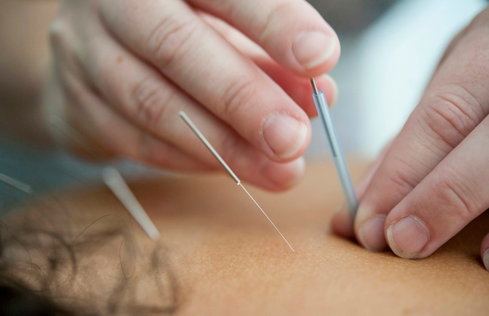 Acupuncture in progress